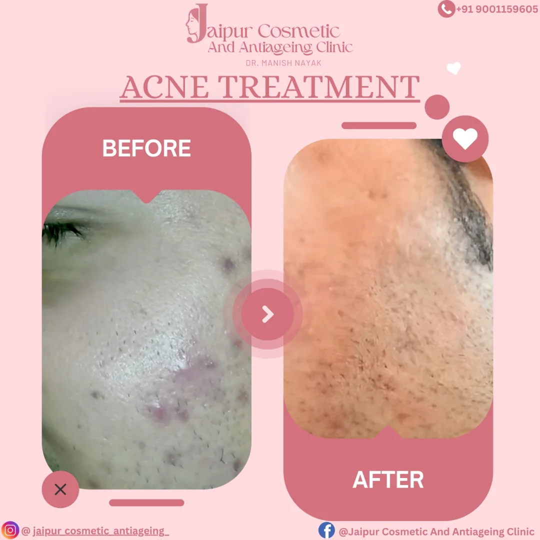 Acne-Free, Confidence Reborn!Another amazing acne treatment transformation that proves skincare