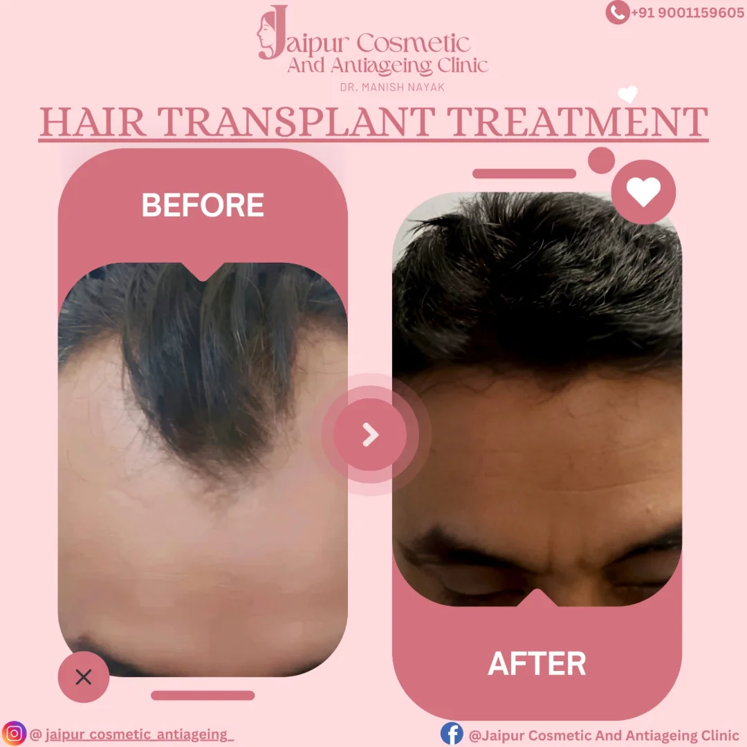 Bald to Bold - Real Hair. Real Confidence.This amazing hair transplant transformation is not ju