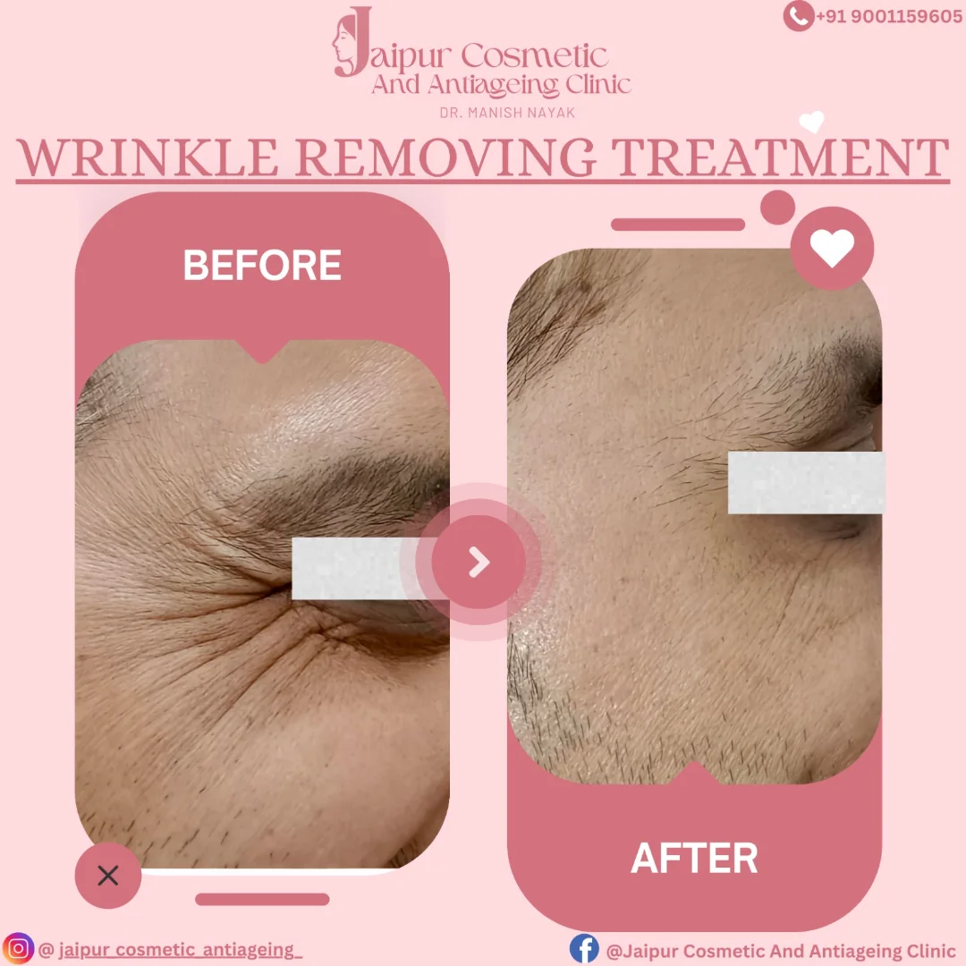 Bye Bye Wrinkles. Hello Youth!Fine lines and wrinkles don’t define your age—your confidence doe