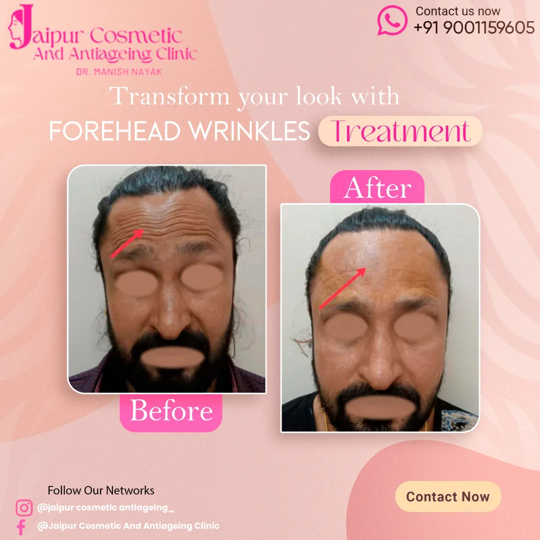 Fine lines and wrinkles can be managed very effectively with antiwrinkle injections. It takes 3