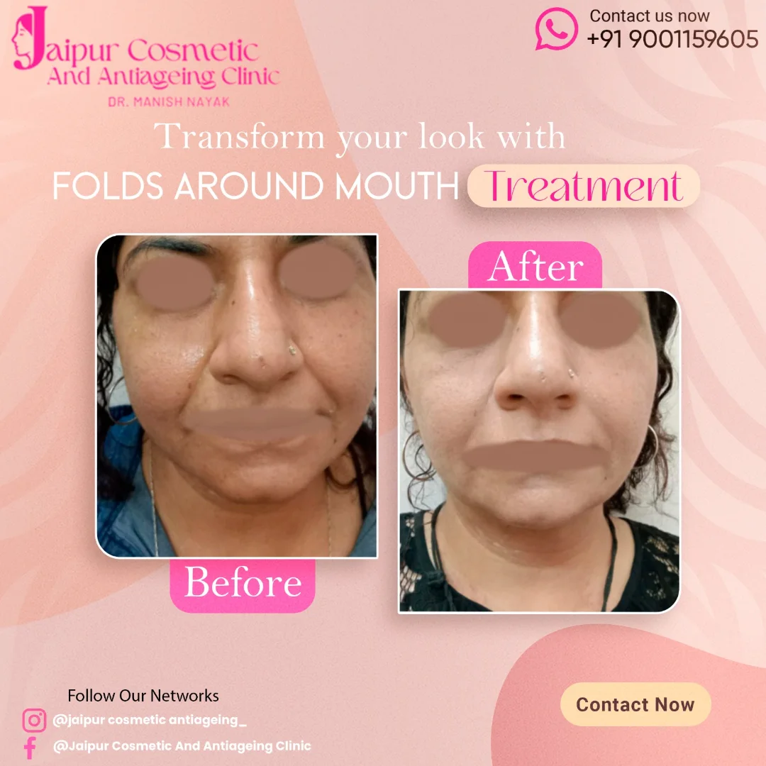 Folds around mouth extending from below the nose upto corners of the lips known as nasolabial f