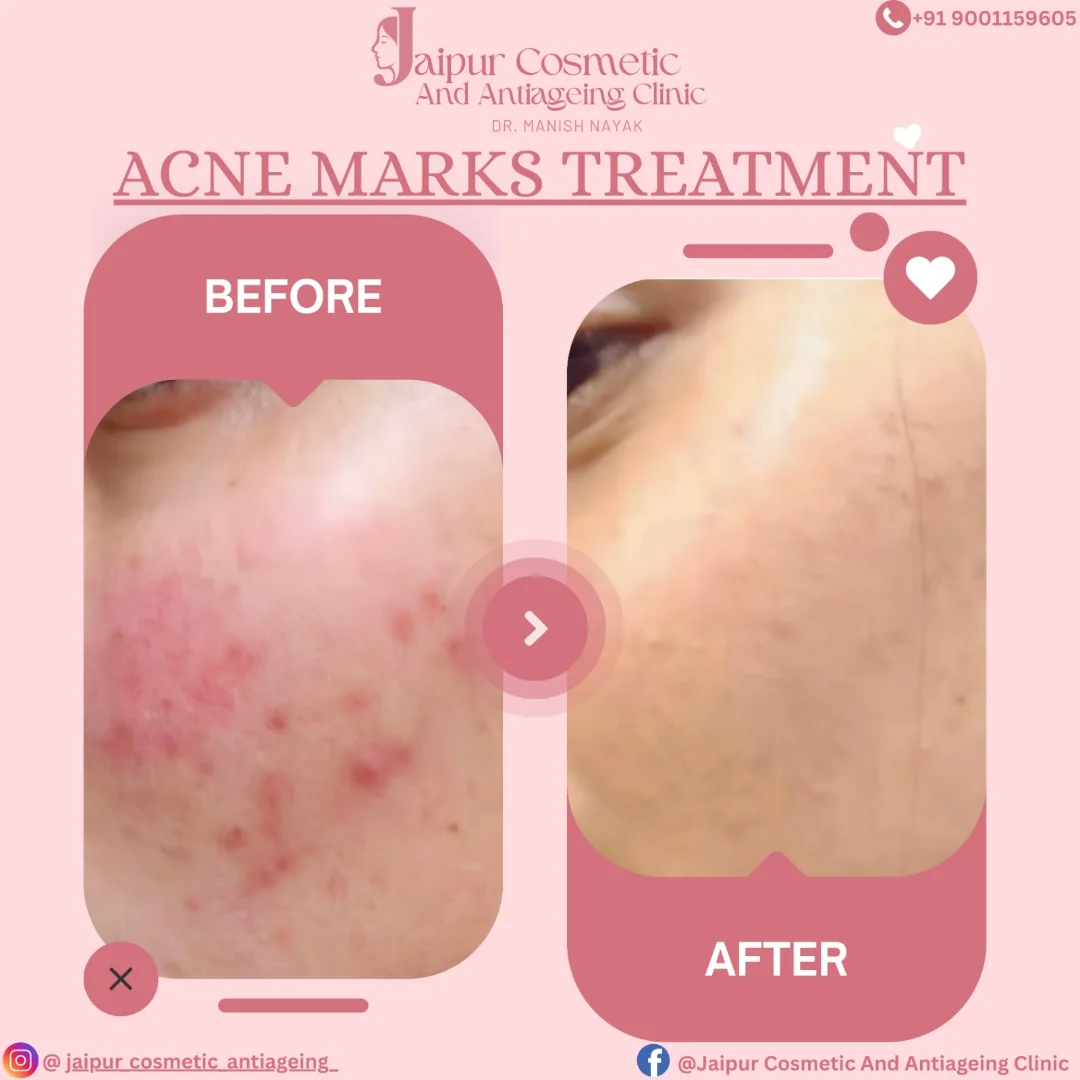 From Acne Marks to Clear Confidence!Acne ke daag bhi utne hi takleef dete hain jitna acne khud.