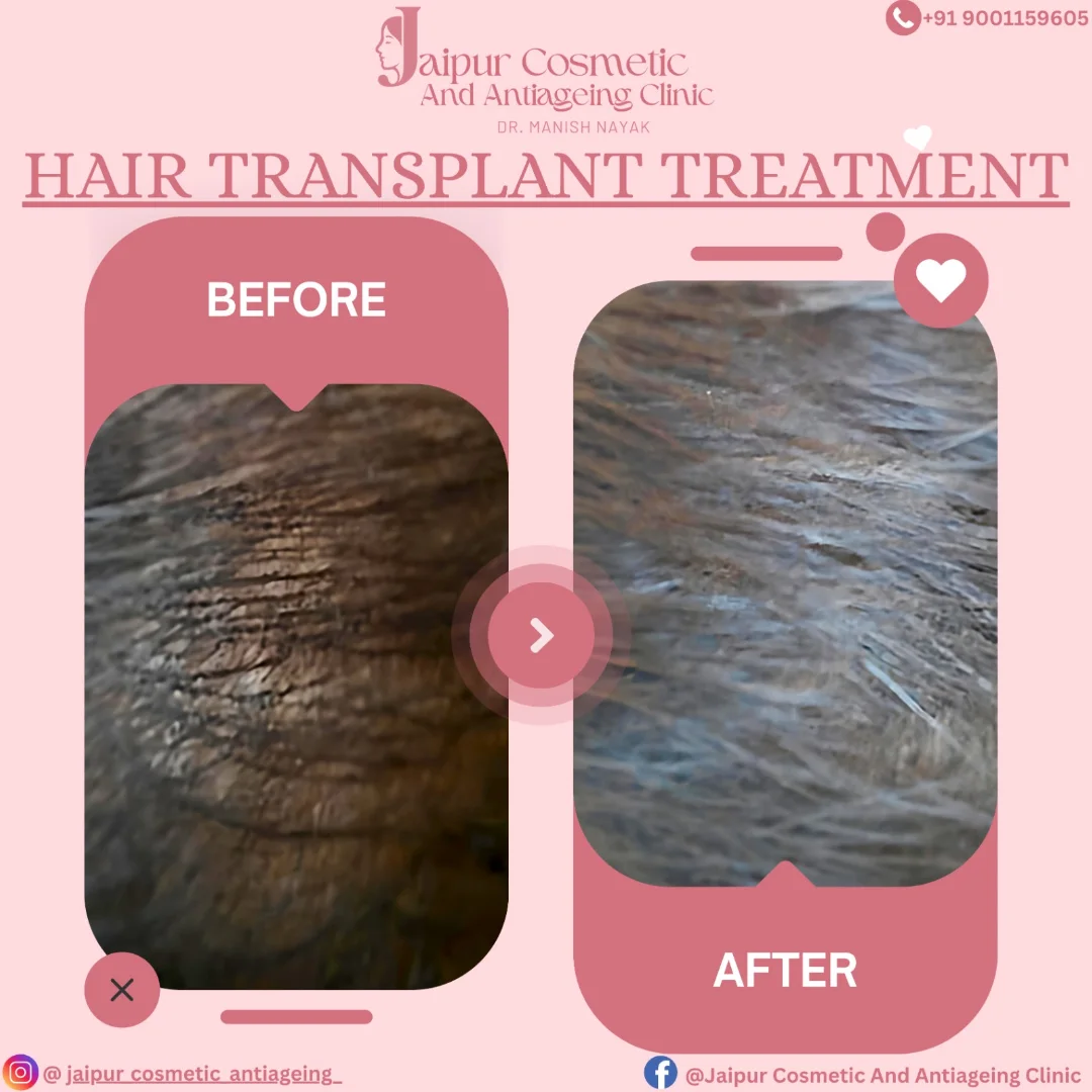 Hair PRP Transformation – Natural Regrowth. Visible Confidence.This isn’t just hair growth—this