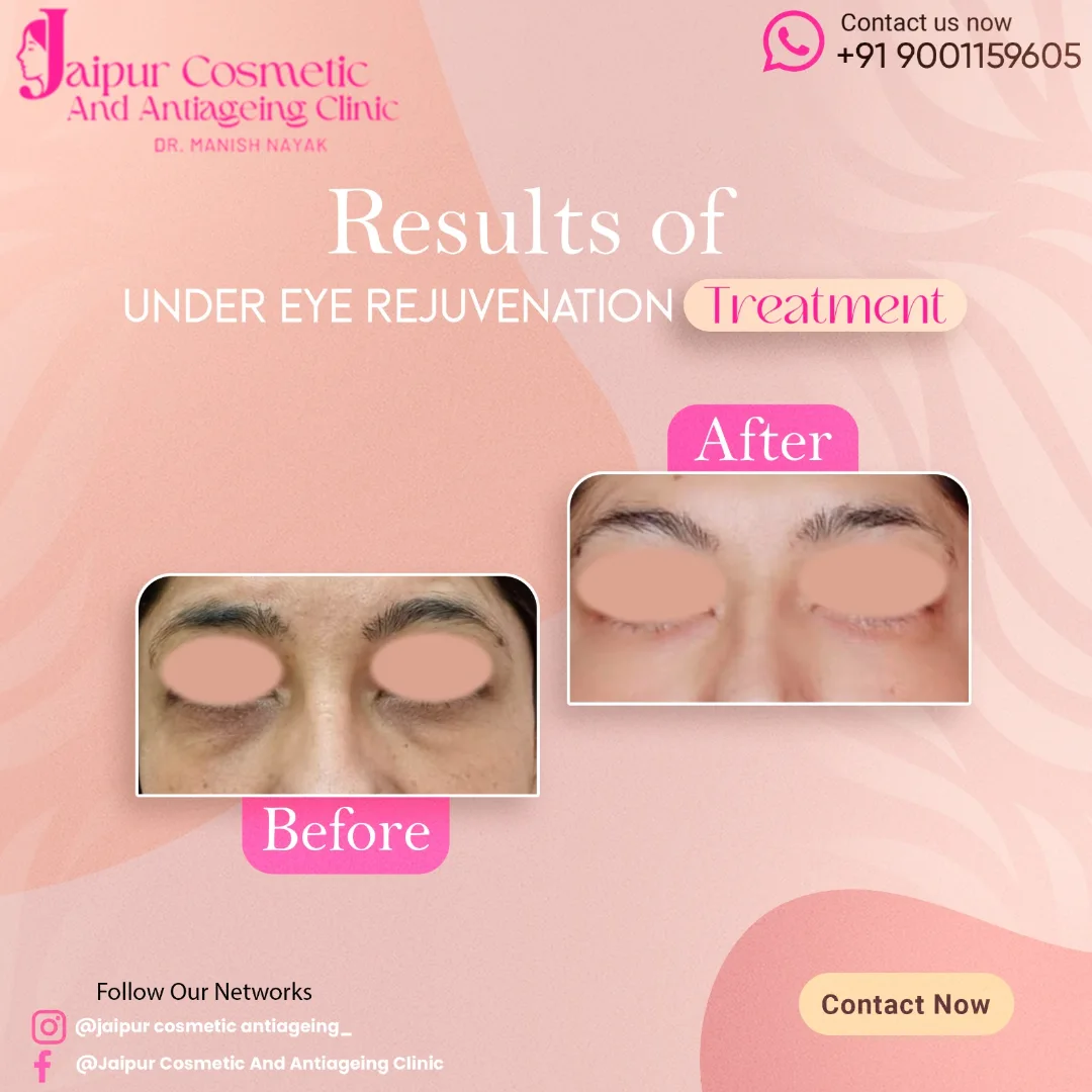 Under eye rejuvenation depends on various factors. Peels and prp can be used initially but in a
