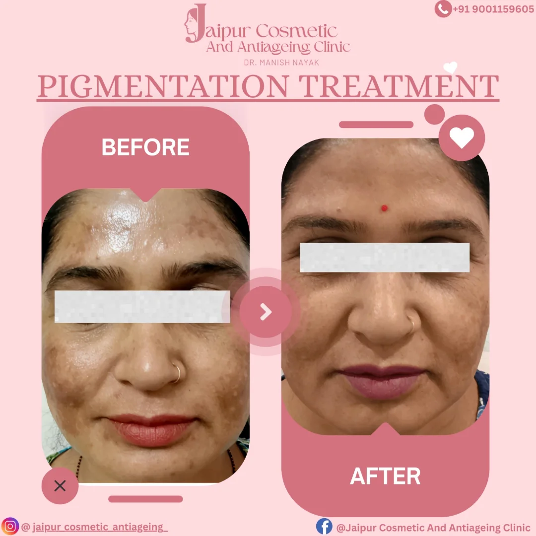 ✨ Real Results - Real Confidence ✨Pigmentation is not just a issue—it affects self-esteem too.